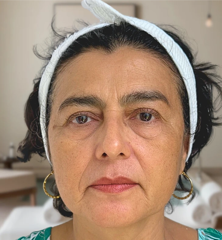 Antes del tratamiento Hifu