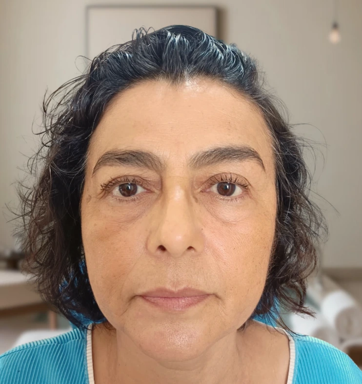 Resultado después del tratamiento Hifu